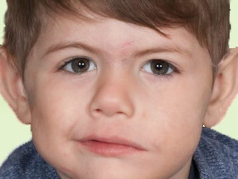 Paediatric Facial Palsy